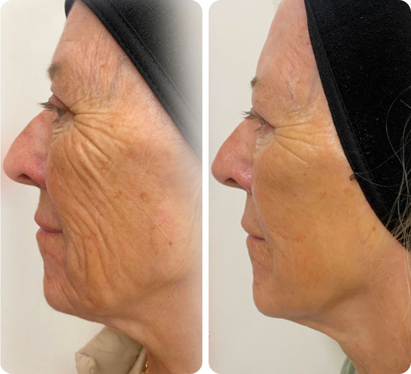 After 2 low energy treatments.
Courtesy of Body Sculpt Aesthetics.