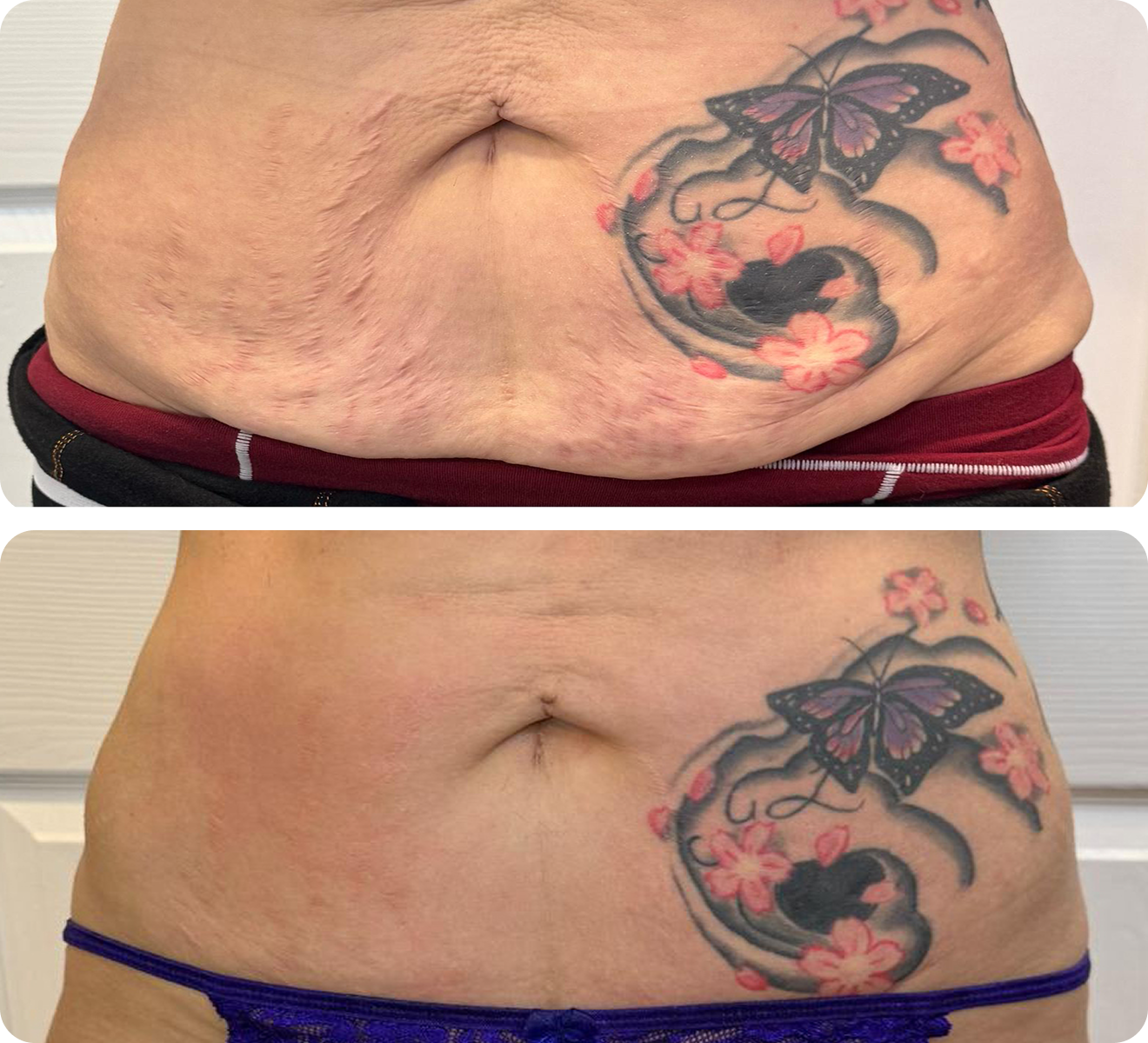 Before and after 4 skin-tightening treatments on the abdomen with T-Shape 2 to reduce loose skin after weight loss.