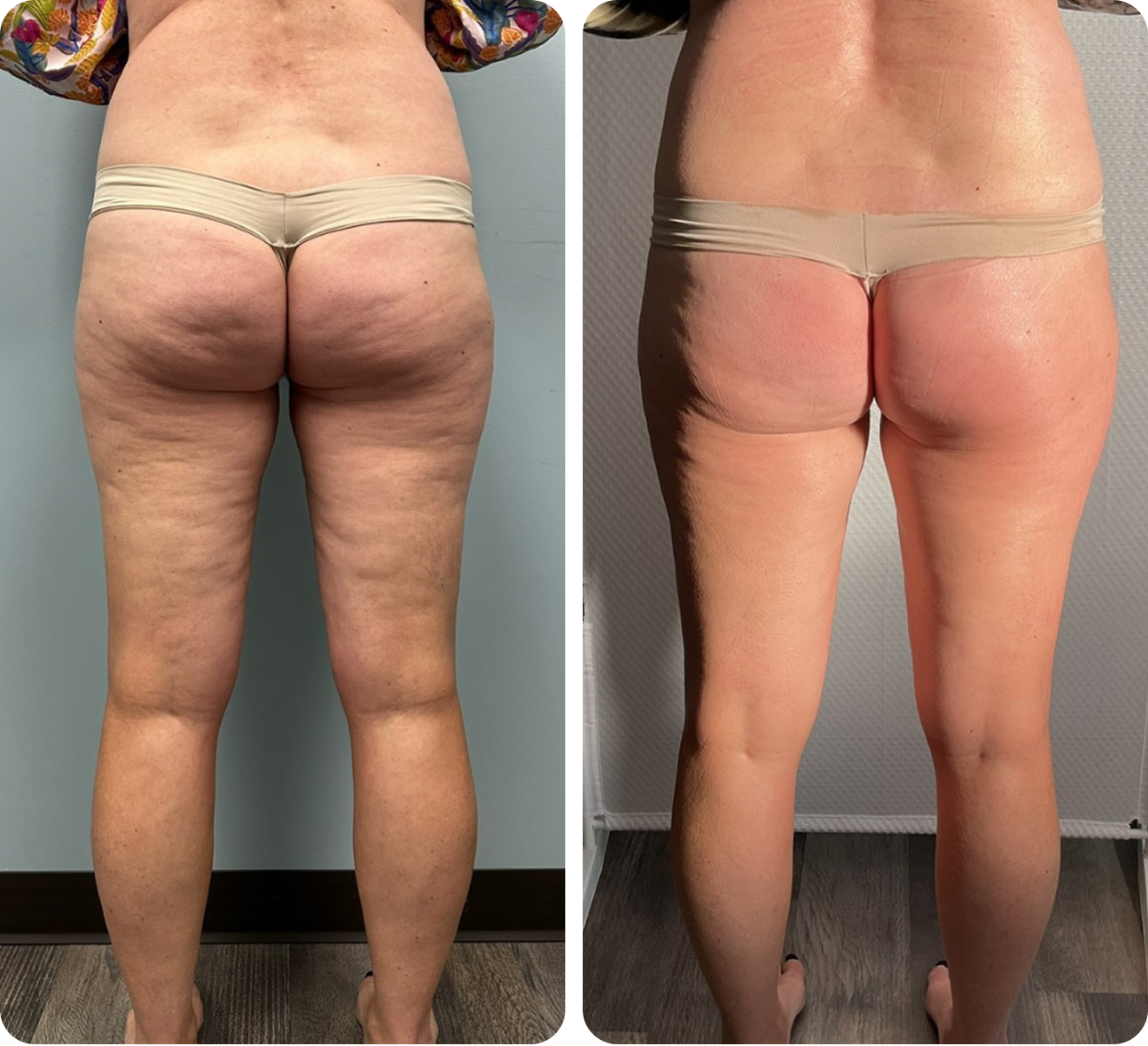 Before and after 3 cellulite treatments on the buttocks and legs with T-Shape 2.