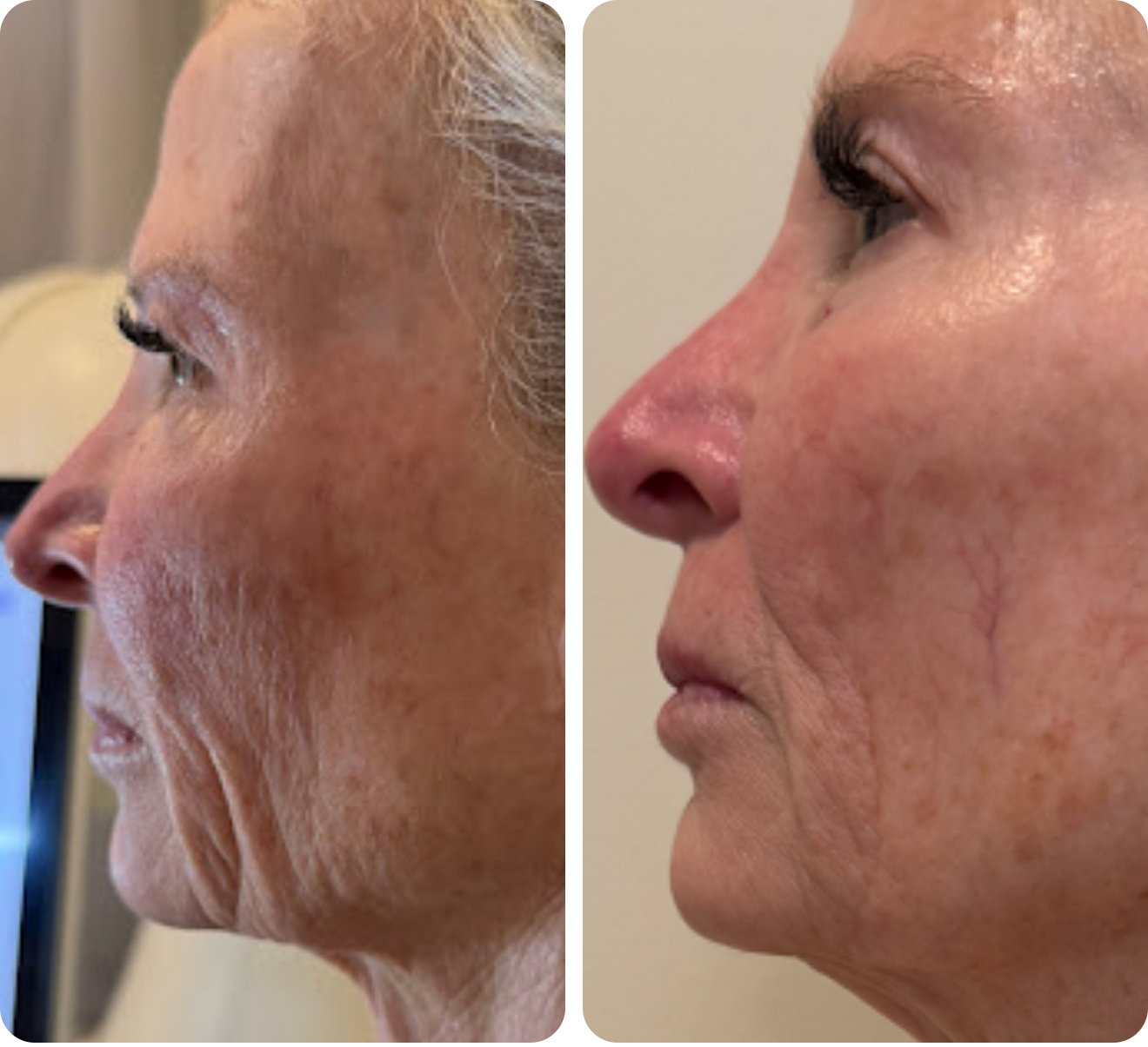 Before and after 8 skin-tightening treatments on the face with T-Shape 2.