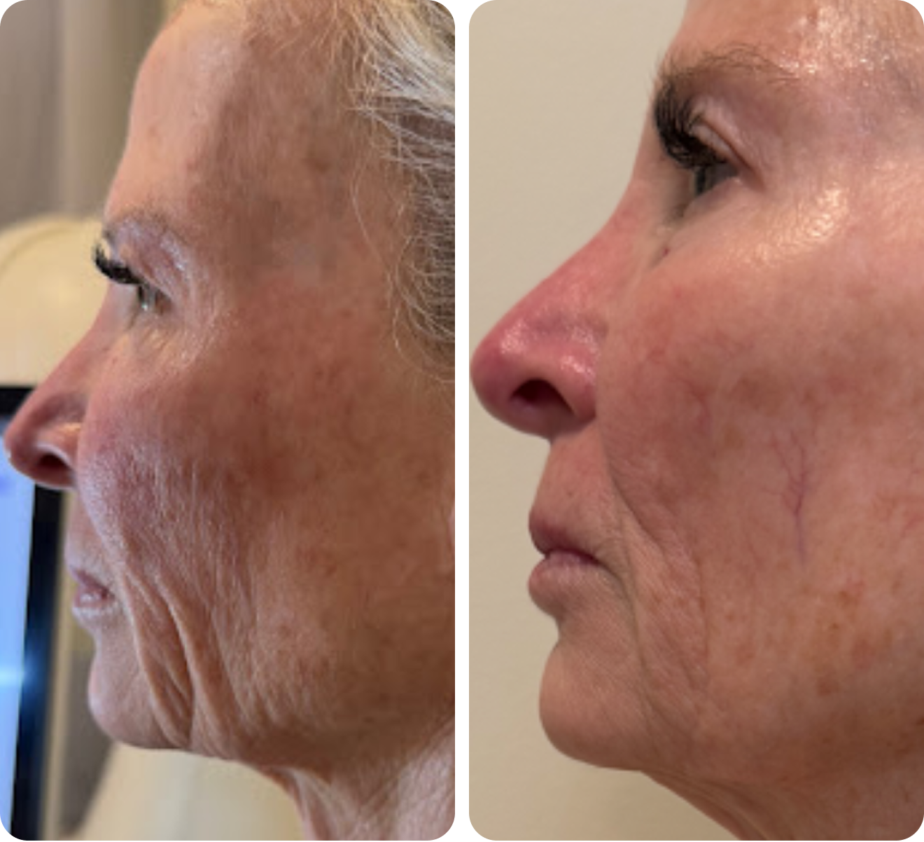 Before and after 8 skin-tightening treatments on the face with T-Shape 2.