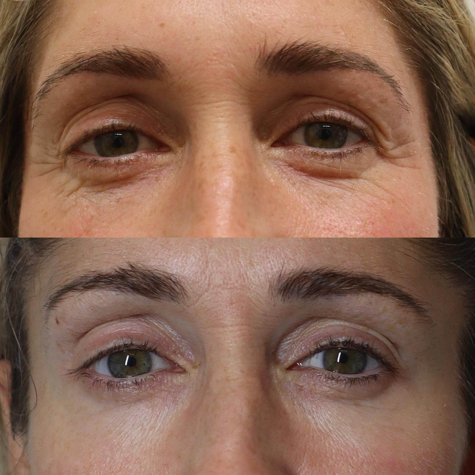 4 Weeks after 3 low-energy treatments on the eye area with Neogen. Courtesy of La Ross Clinic.