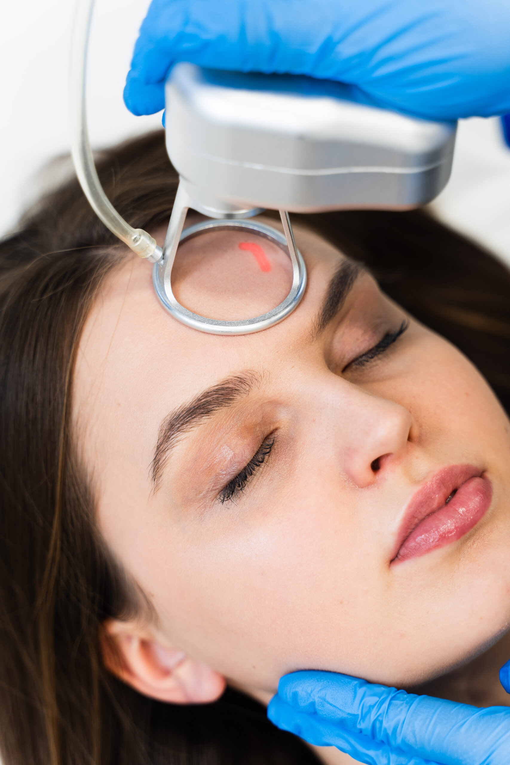 Woman receiving a laser skin treatment on her forehead.