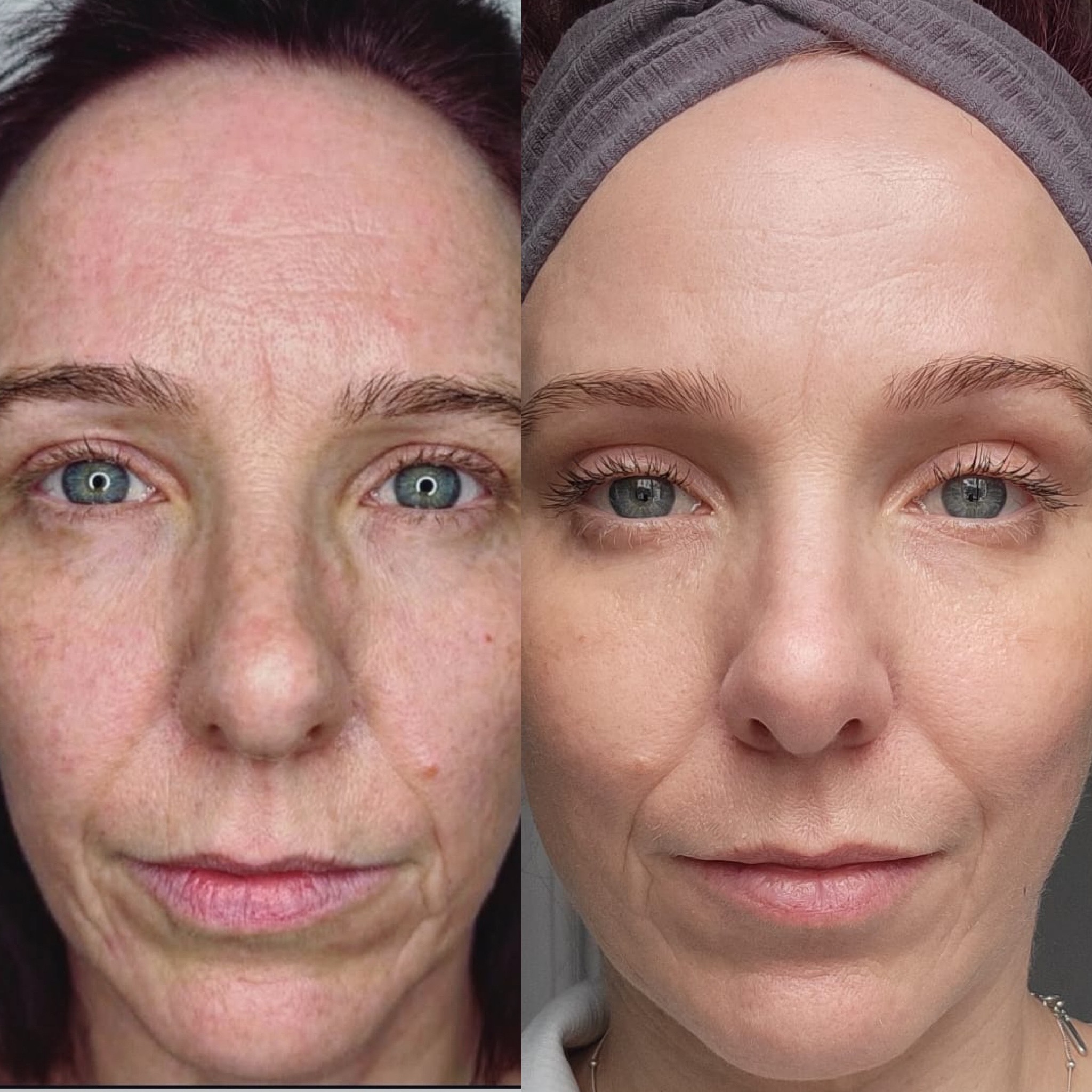 3 months after 1 medium energy treatment with Neogen. Courtesy of Plasmatology.