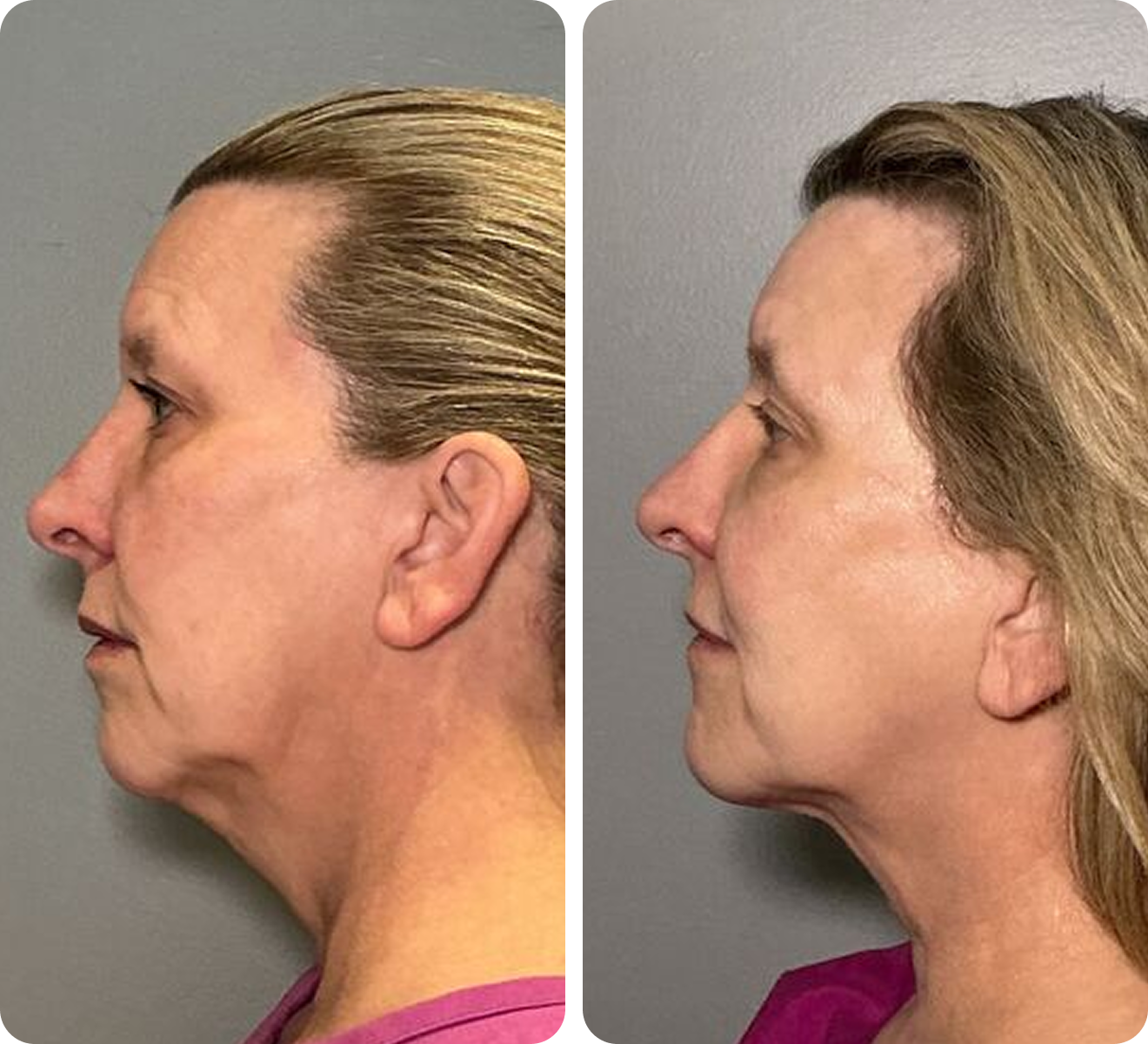 Before and after 3 skin-tightening treatments with T-Shape 2.